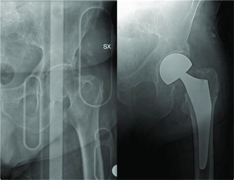 Hemiarthroplasty for Femoral Neck Fracture : JBJS Essential .